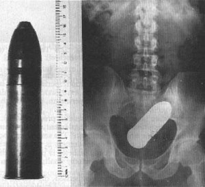 Une balle de fusil dans le rectum